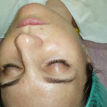 Карбокситерапия
                    Косметолог Ирина Орел Харьков