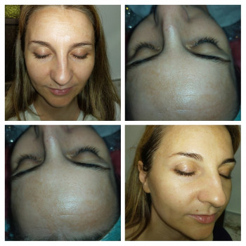 Карбокситерапия
                    Косметолог Ирина Орел Харьков