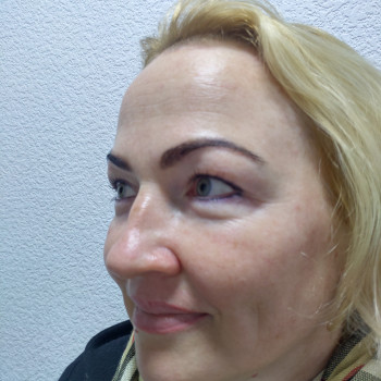 Карбокситерапия
                    Косметолог Ирина Орел Харьков