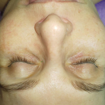 Феруловый Пилинг
                    Косметолог Ирина Орел Харків