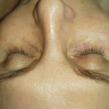 Феруловый Пилинг
                    Косметолог Ирина Орел Харків