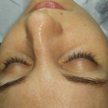 Феруловый Пилинг
                    Косметолог Ирина Орел Харків