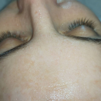 Феруловый Пилинг
                    Косметолог Ирина Орел Харків