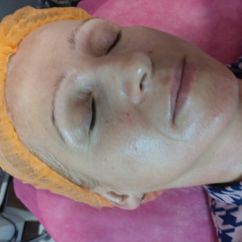 Феруловый Пилинг
                    Косметолог Ирина Орел Харків