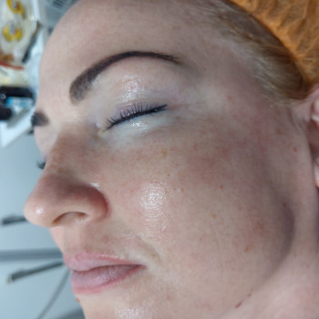 Феруловый Пилинг
                    Косметолог Ирина Орел Харків