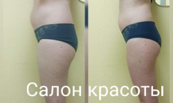 Антицеллюлитный массаж Салон красоты Мрия Житомир