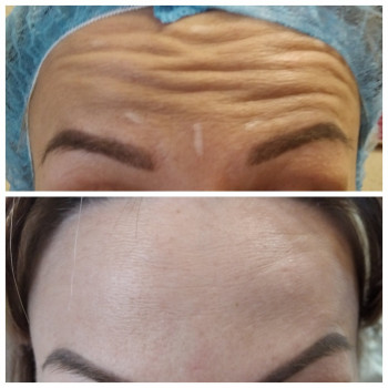 Введение ботокса  в лобные мышцы и межбровье. Результат чере, фото - косметолог Оксана Костецкая