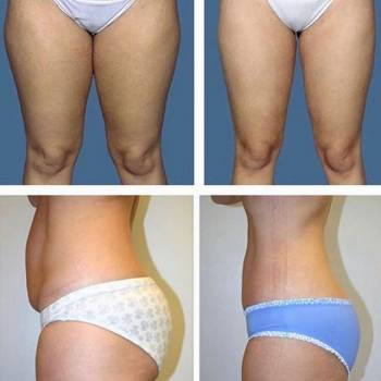 Фото с портфолио Велашейп Днепр