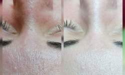 Микродермабразия лица Салон красоты Мрія Житомир