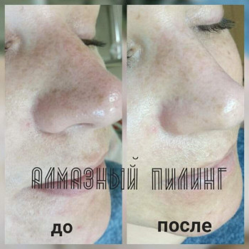 Микродермабразия лица
                    Салон краси Мрія Житомир