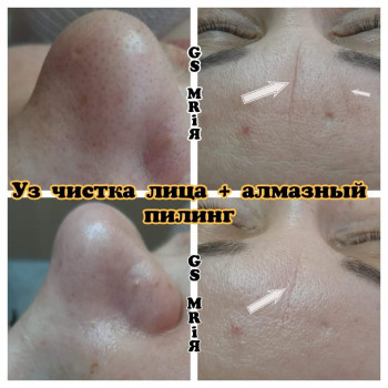 Микродермабразия лица
                    Салон краси Мрія Житомир