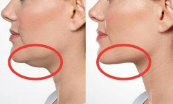 FAT APOPTOSIS – липолитик для лица и тела Маурицио Чеккарелли, REVANELLE SLIM BODI Лікар-косметолог Майя Київ