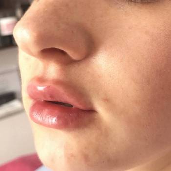 Губки сразу после аугментации гиалуроновой кислотой