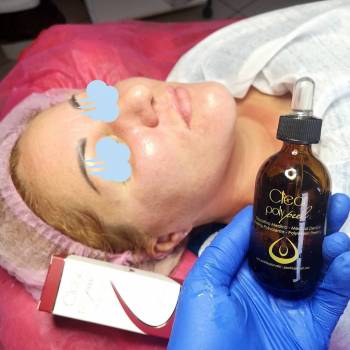 Пилинг решение многих проблем