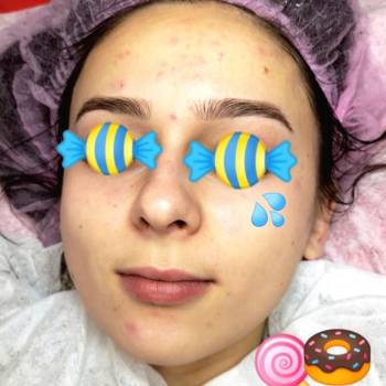 Лечение акнэ
Угревая болезнь