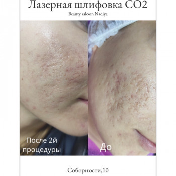 Лазерная шлифовка СО2
                    Косметологический центр Надія Кривой Рог