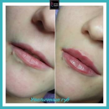 Увеличение губ. Увлажнение +натуральный объем