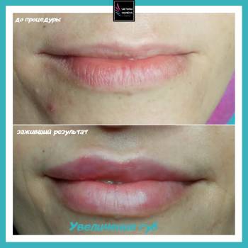 Увеличение губ. Коррекция ассиметрии, изменеие формы и объем