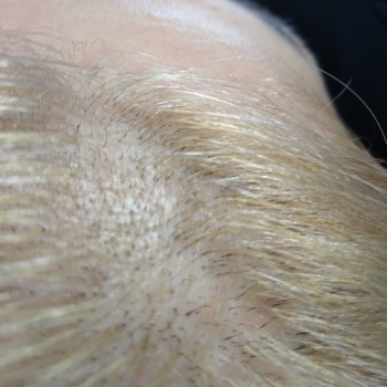 Результат після 4х процедур