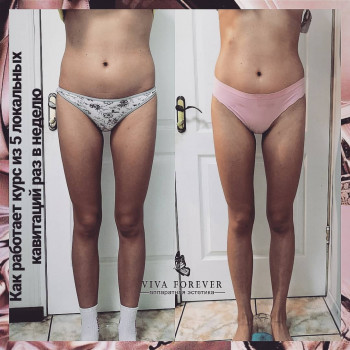 Комплексная процедура сеанс вакуумно-роликового массажа + кавитация (зонально)
                    Студия татуажа Viva Forever Кривой Рог