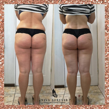 Ультразвуковая кавитация
                    Студія татуажу Viva Forever Кривий Ріг