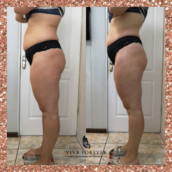 Ультразвуковая кавитация
                    Студія татуажу Viva Forever Кривий Ріг