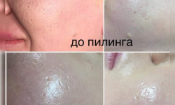Пилинг Косметолог Ксения Кропивницкий