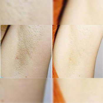 Пилинг
                    Косметолог Ксения Кропивницкий