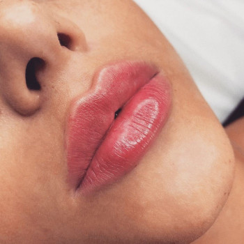 Увеличение и бьютификация губ
                    Косметолог Ирина Кривой Рог