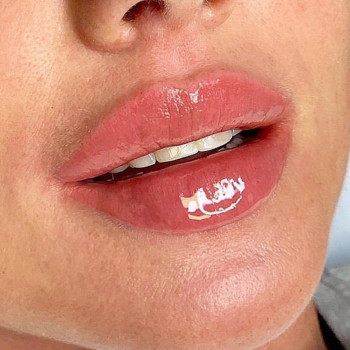 Увеличение и бьютификация губ
                    Косметолог Ирина Кривой Рог