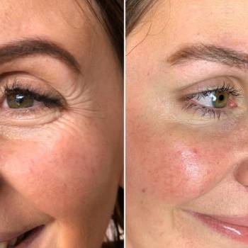 Ботокс. Гусиные лапки