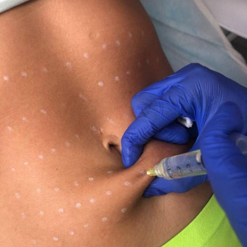 Липолитическая коррекция живот, бедра, лицо, руки, ноги
                    Косметолог Дарья Одесса