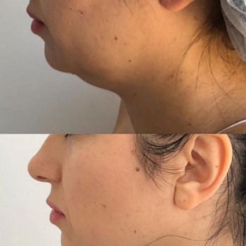 Липолитическая коррекция живот, бедра, лицо, руки, ноги
                    Косметолог Дарья Одесса