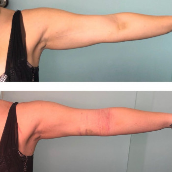 Липолитическая коррекция живот, бедра, лицо, руки, ноги
                    Косметолог Дарья Одесса