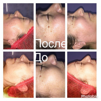 Хиропластический массаж лица