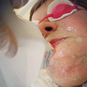 Эпиляция подбородка