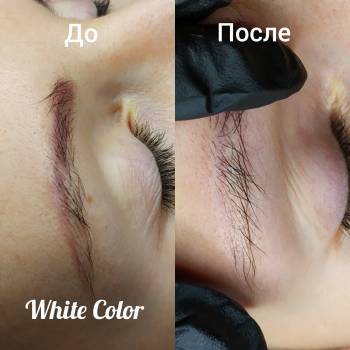 Удаление некачественного татуажа ремувером White Color