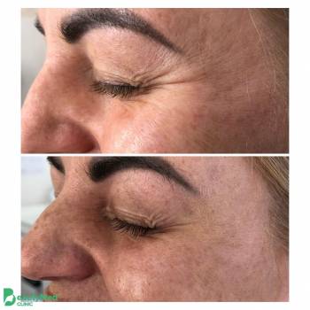 Ботулінотерапія