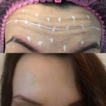 Инъекции ботулотоксина