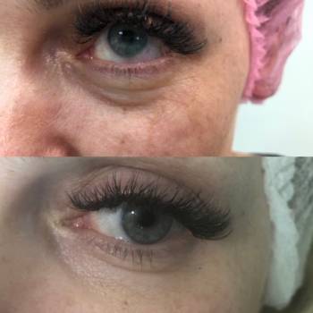 Избавление от морщин возле глаз