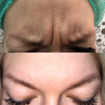 Инъекции Botox, Dysport
                    Косметолог Юлия Винославская Киев