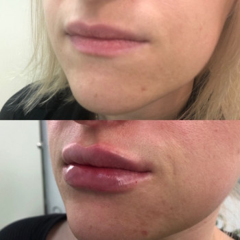 Увеличение губ
                    Косметолог Юлия Винославская Киев