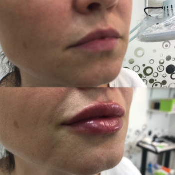 Увеличение губ
                    Косметолог Юлия Винославская Киев