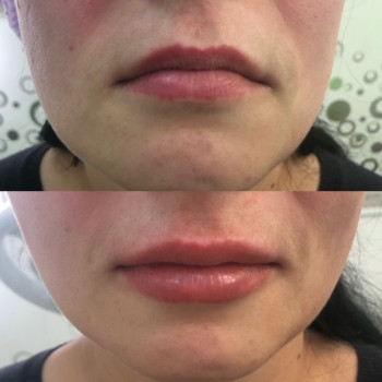 Увеличение губ
                    Косметолог Юлия Винославская Киев