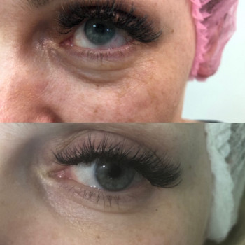 Биоревитализация (биорепарация)
                    Косметолог Юлия Винославская Київ