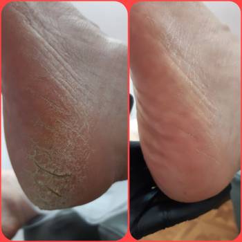 Трещинки на пятках