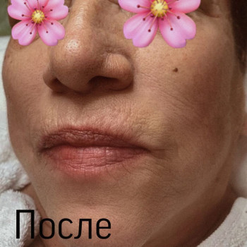 Биоармирование После.