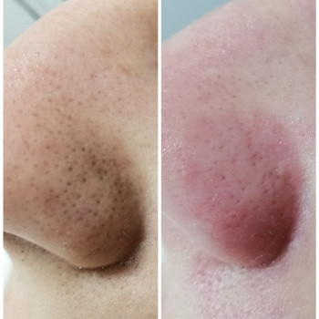 Комбинированная чистка лица