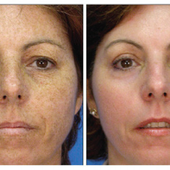 Мезотерапия лица
                    Косметолог Юлия Винославская Київ