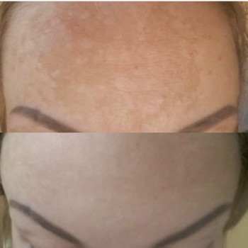 Мезотерапия лица
                    Косметолог Юлия Винославская Київ